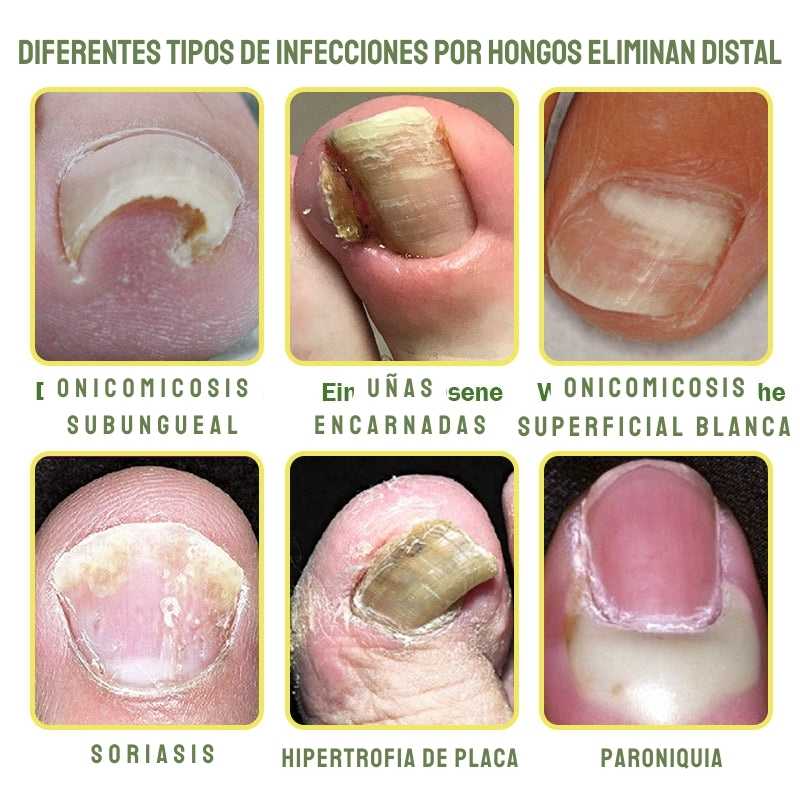 Furzero™ Nail Defense - Uñas Fuertes y Sanas