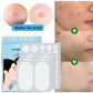 Acne Patches: Dile Adiós a Cada Granito